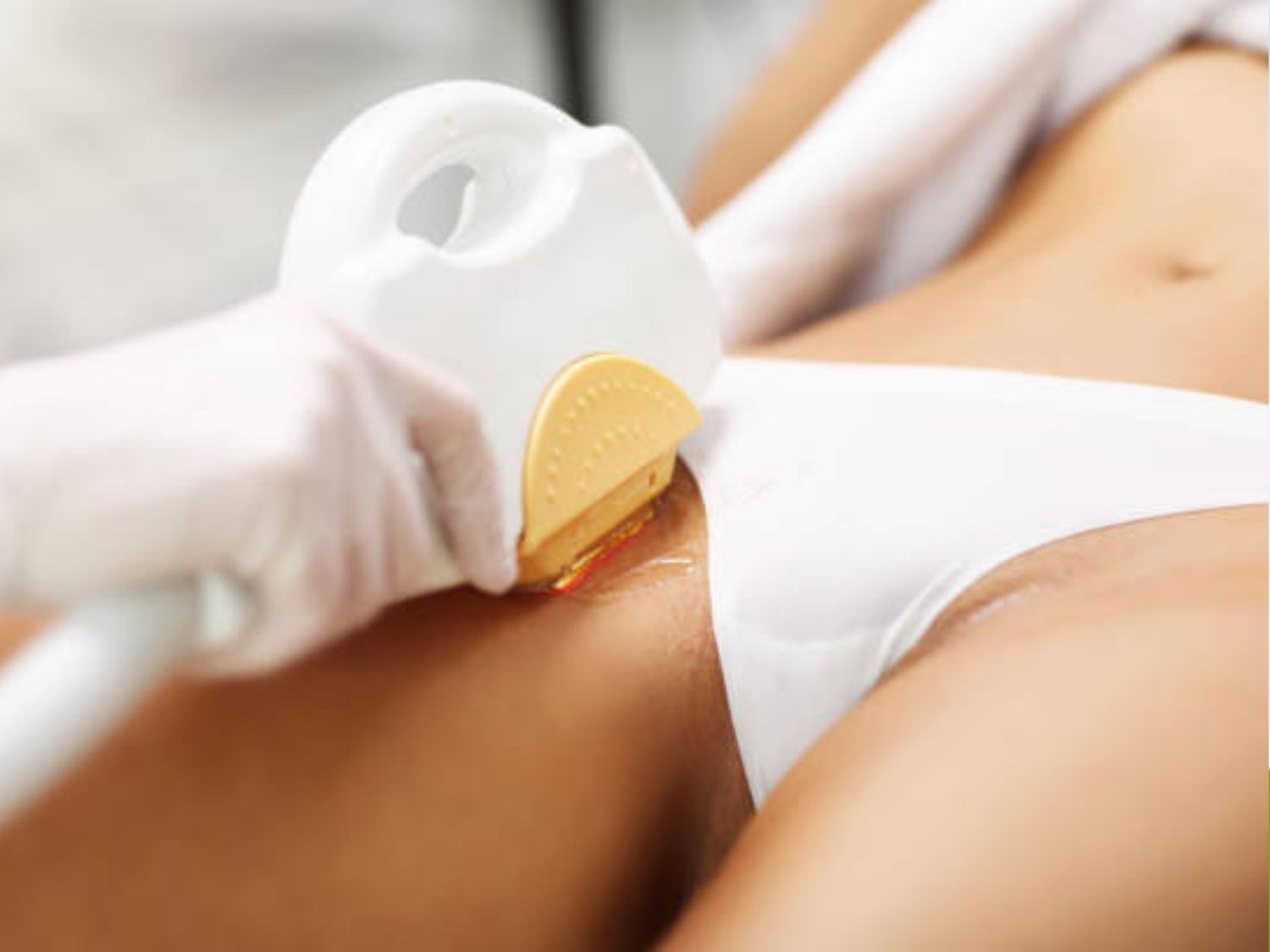 triệt lông diode laser tại Kangnam uy tín, sạch lông, an toàn