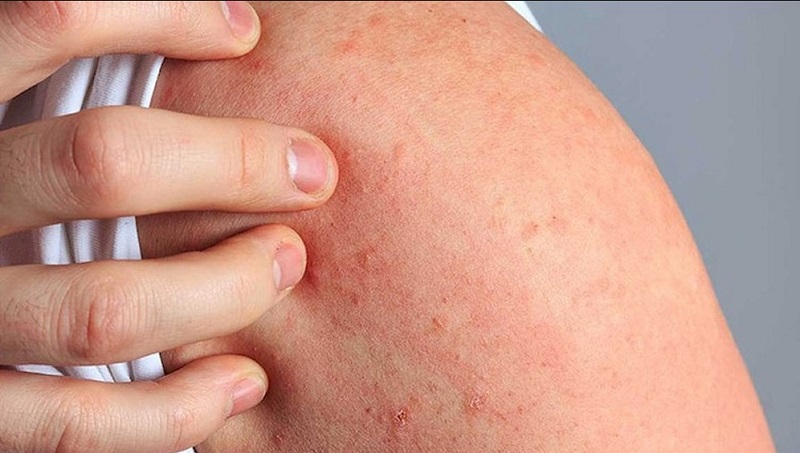 Da có thể bị dị ứng sau khi tắm trắng