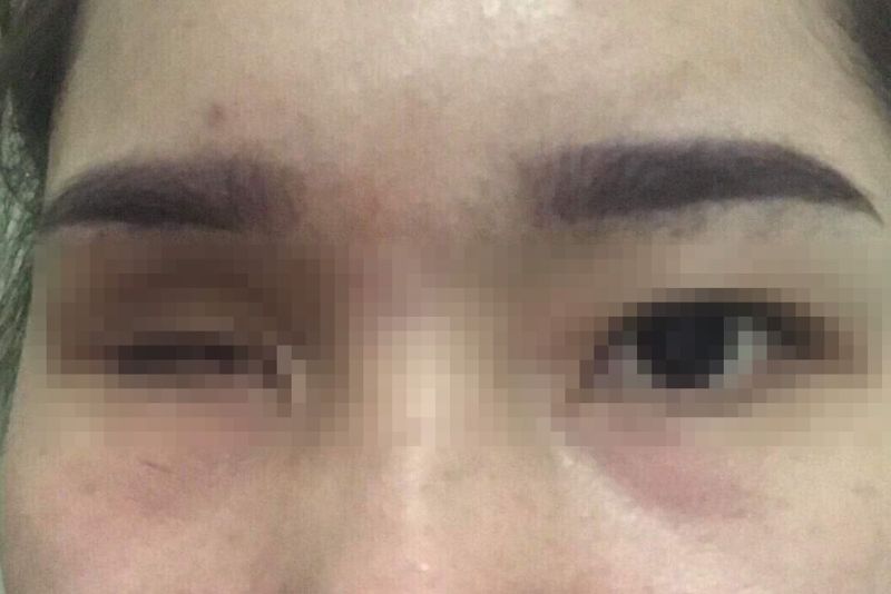 Hình ảnh minh họa biến chứng hoại tử quanh vùng mắt sau khi tiêm filler