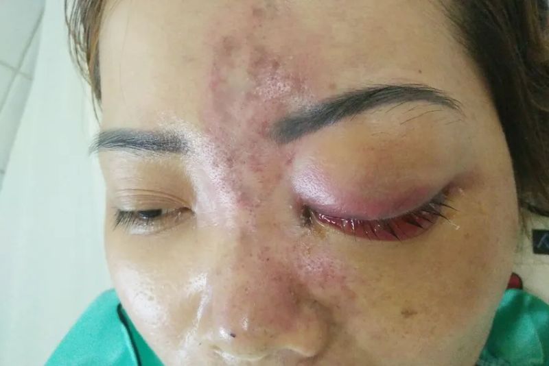 Trường hợp ảnh hưởng thị lực sau tiêm filler tại cơ sở không đảm bảo