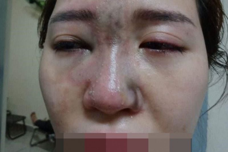 Tuyệt đối không tự ý nặn, xoa bóp, chích hút dịch mũi ở nhà