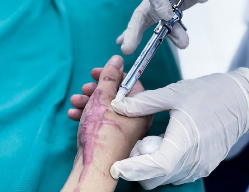 Tiêm trị sẹo lồi sử dụng thành corticoid để làm mềm sẹo
