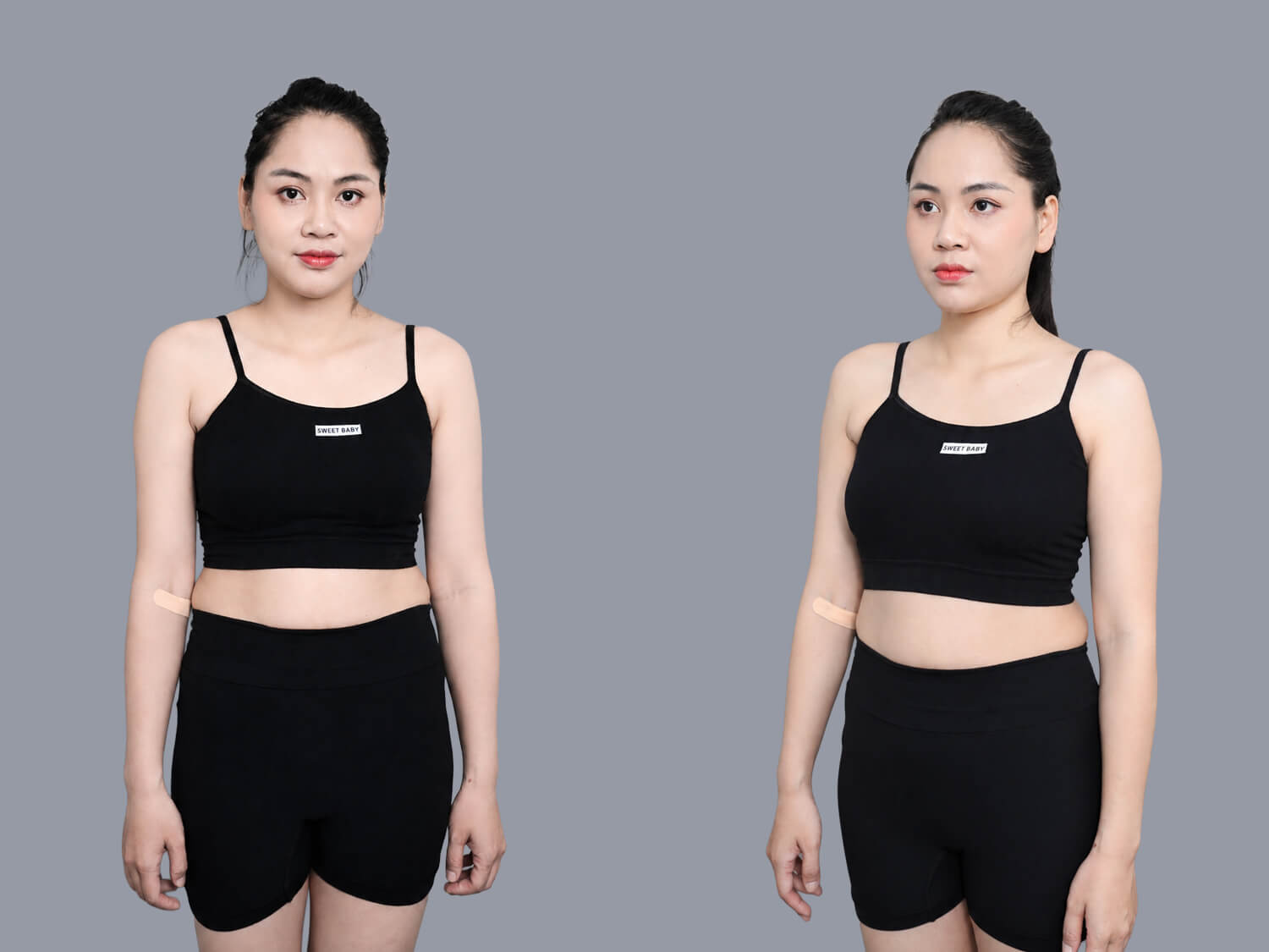 Khách hàng gặp tình trạng mỡ thừa tích tụ ở các vùng trên cơ thể