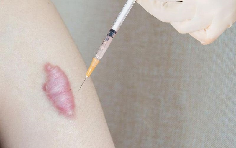 Tiêm trị sẹo lồi phù hợp với những vết sẹo nhỏ