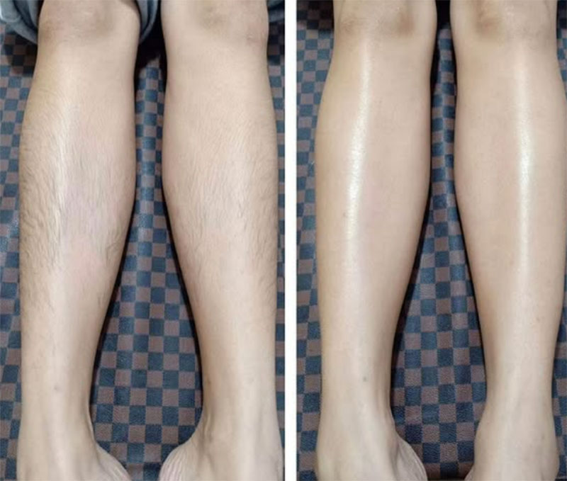 Triệt lông chân bằng Diode Laser hiệu quả cao