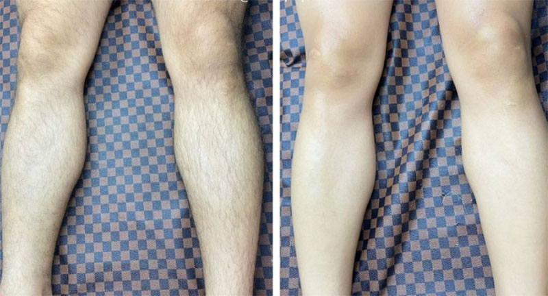 Sạch lông sau 1 liệu trình