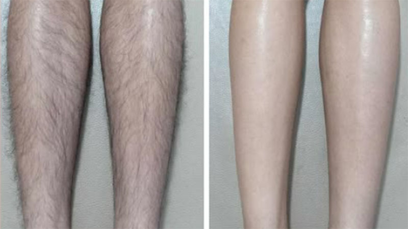 công nghệ triệt lông bằng laser hiện đại được đánh giá là an toàn và không ảnh hưởng đến sức khỏe