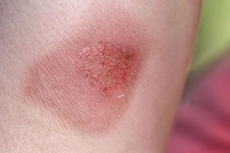 Triệt lông sai cách gây bỏng da, thay đổi sắc tố da...