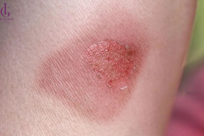 Bỏng da do triệt sai cách