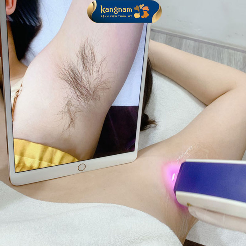 Dịch vụ triệt lông tại Kangnam ứng dụng công nghệ Diode Laser