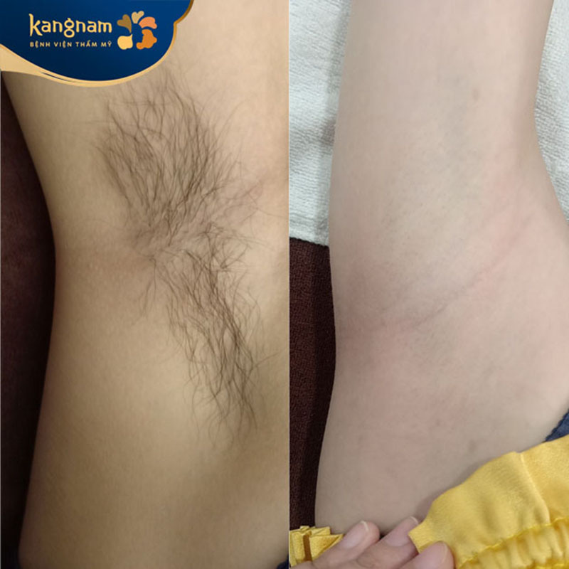 Sạch lông, sáng da sau buổi triệt