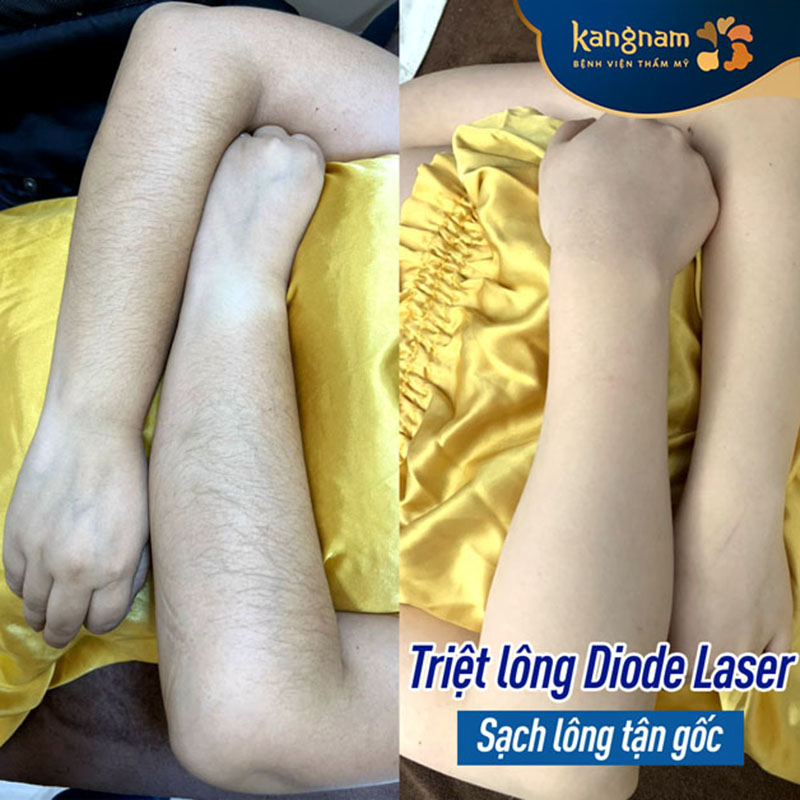 Công nghệ triệt lông ảnh hưởng đến chi phí