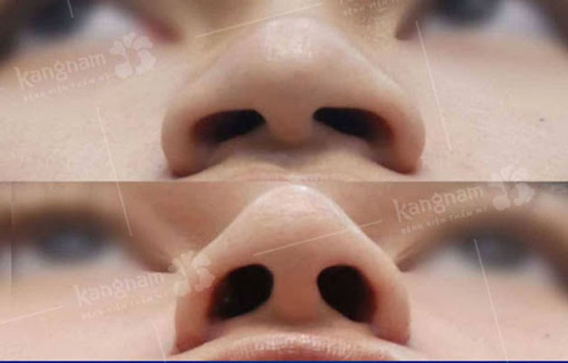 Bác sĩ thao tác bên trong để cuộn nhẹ phần chân cánh mũi, giúp thu hẹp lỗ mũi