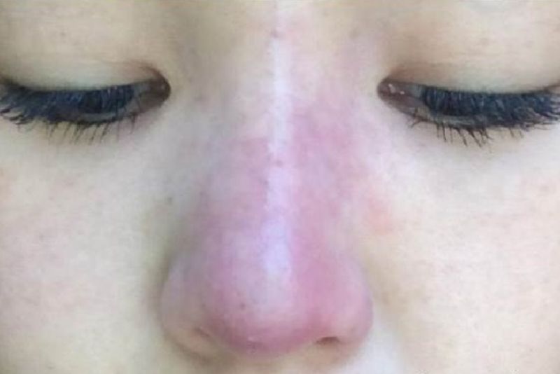 Sưng đỏ sau tiêm filler mũi cần thăm khám ngay