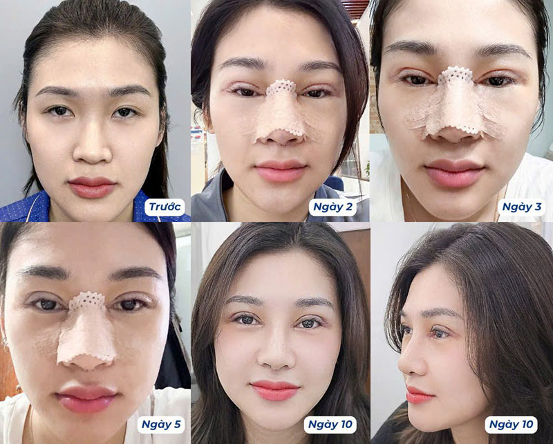 Khách hàng hồi phục nhanh sau nâng mũi tại Kangnam