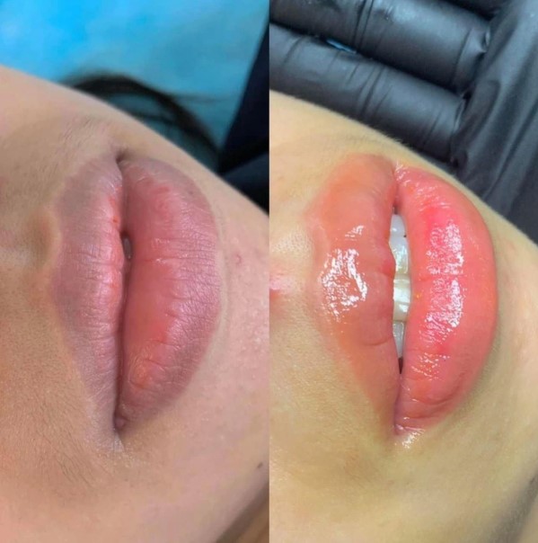Kỹ thuật viên sẽ tiến hành khử thâm môi cho khách hàng