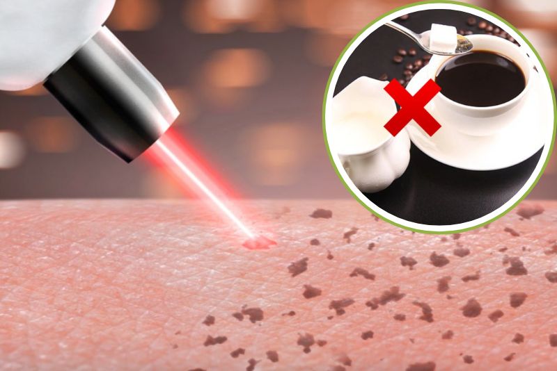 Bắn laser nên kiêng thực phẩm cay nóng, gây sẹo khoảng 7-14 ngày