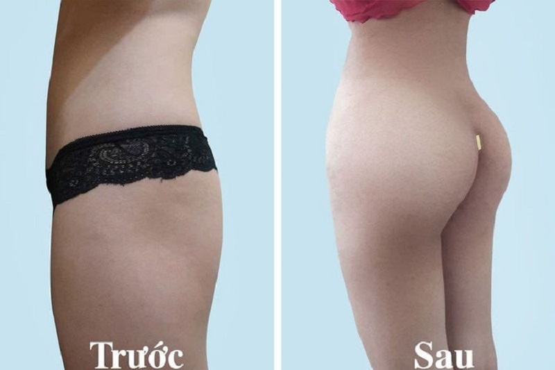 Phẫu thuật nâng mông đặt túi độn giúp vòng 3 săn chắc, quyến rũ hơn