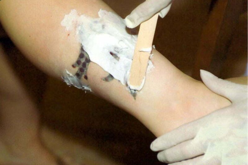 Kem xóa xăm cần nhiều thời gian