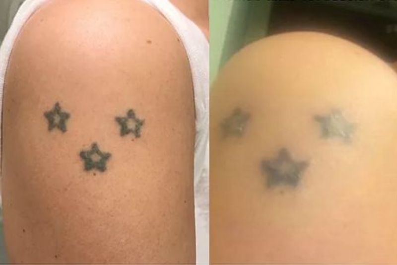 Xóa xăm bằng kim chỉ làm mờ hình xăm