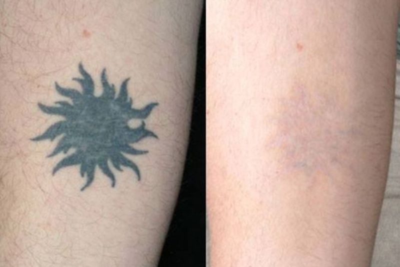 Có nhiều cách xóa xăm không sẹo tại nhà