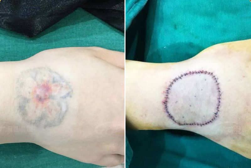Phẫu thuật xóa xăm có thể để lại sẹo