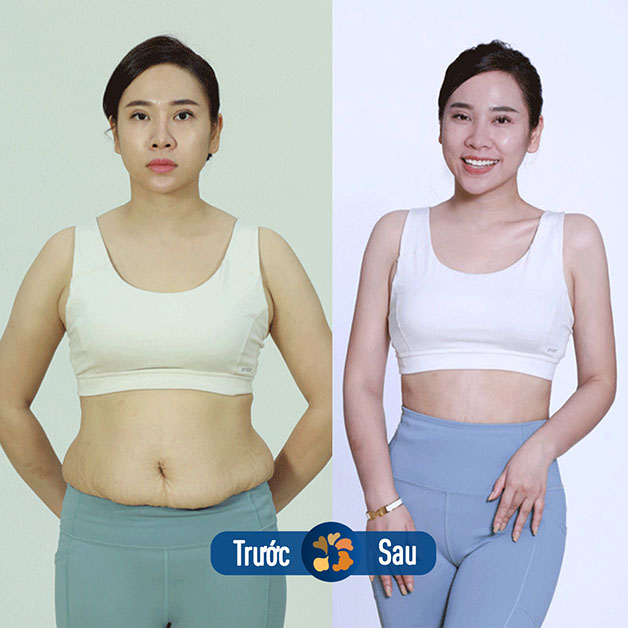 ảnh trước và sau của khách hàng giảm mỡ lipo