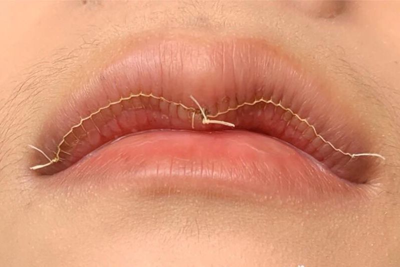 Cắt môi trái tim không ảnh hưởng đến chức năng ăn uống hay phát âm