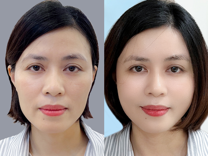 Khách Thanh Nhàn trước và sau khi cấy mỡ mặt