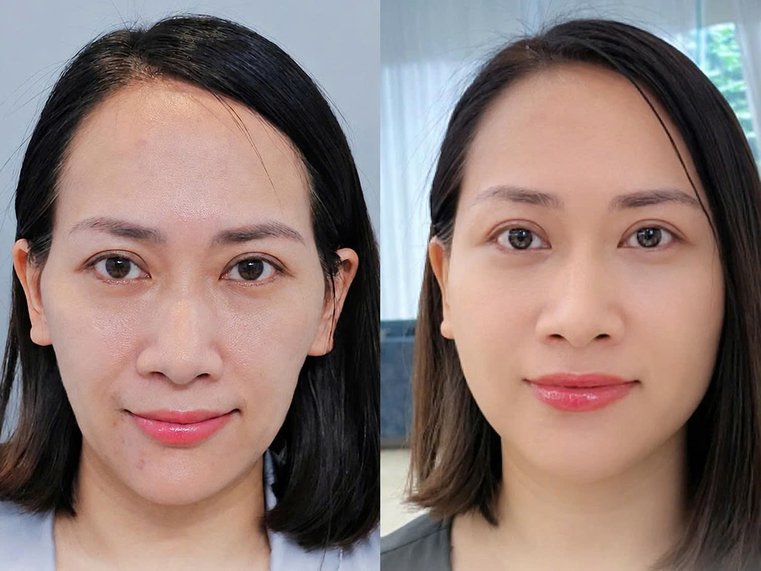 Chị Trà trước và sau khi thực hiện cấy mỡ tự thân tại Kangnam