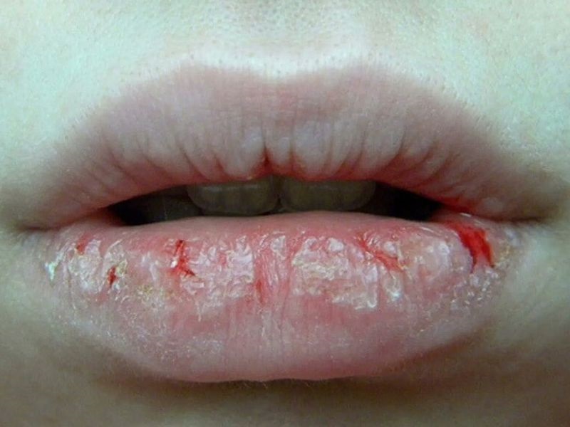 Môi bị ngứa ngáy, chảy máu, bong da hoặc lên mủ