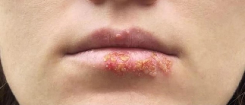 Môi có thể bị nổi mụn nước, ngứa ngáy
