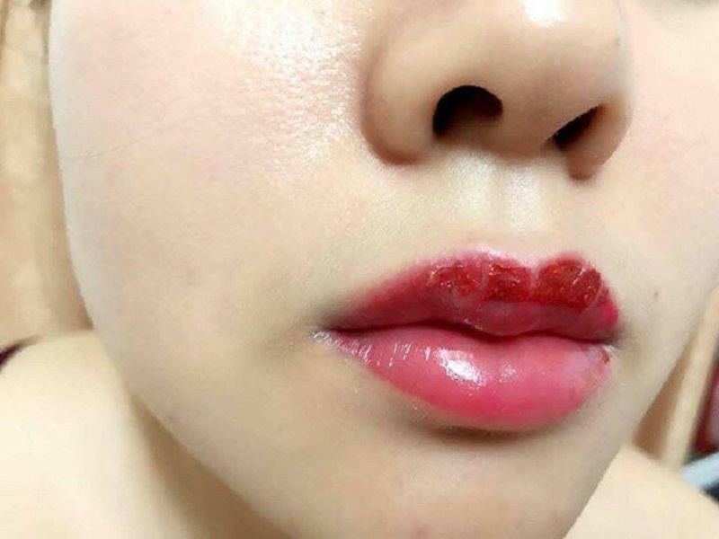 Tình trạng môi đau nhức, sưng tấy sau phun môi