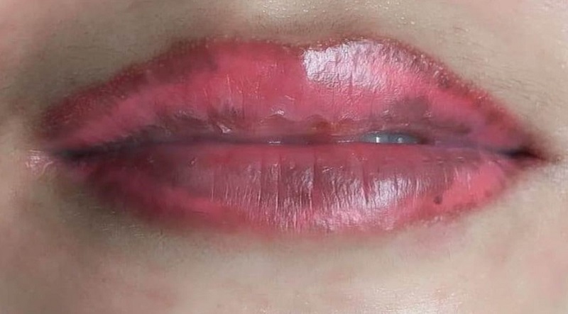 Môi gặp tình trạng thâm tái, tối màu