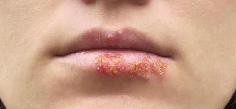 Các nốt mụn sau đó vỡ ra gây đau nhức