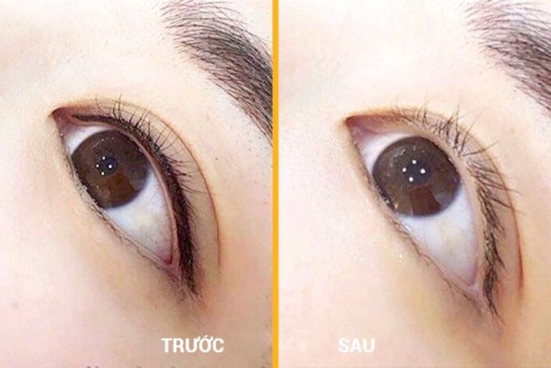 Xóa xăm mí mắt thành công, không để lại sẹo hay thâm