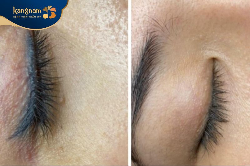 Trước và sau xóa xăm mí mắt: Làn da phục hồi mịn màng tự nhiên