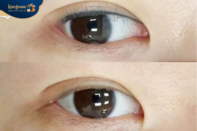 Mí mắt trở lại trạng thái tự nhiên sau xóa xăm bằng công nghệ hiện đại