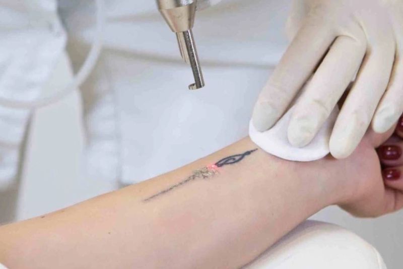 Xóa xăm nên thực hiện khi da đã ổn định từ lần xăm trước đó