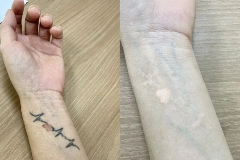 Có nhiều phương pháp xóa hình xăm