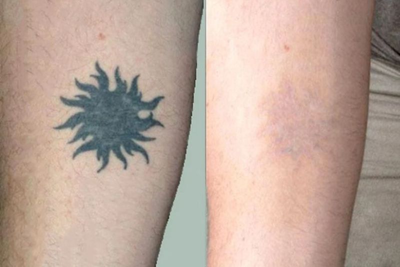 Hình xăm mới không dễ xóa so với hình xăm cũ, vì hình cũ màu mực bị phân tán