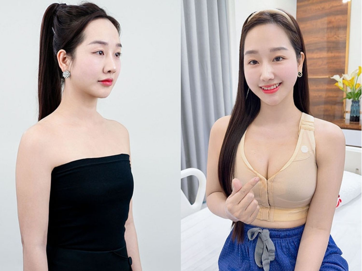 khách hàng trước và sau nâng ngực đặt túi tại Kangnam