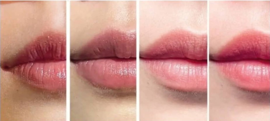 Tình trạng phun môi 20 ngày không lên màu không phải là biến chứng