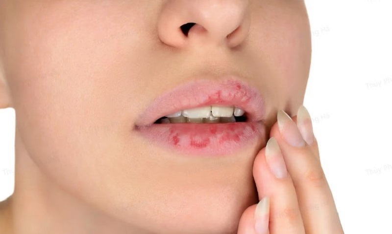 Phun môi 3 ngày bị ngứa do môi đang lên vảy