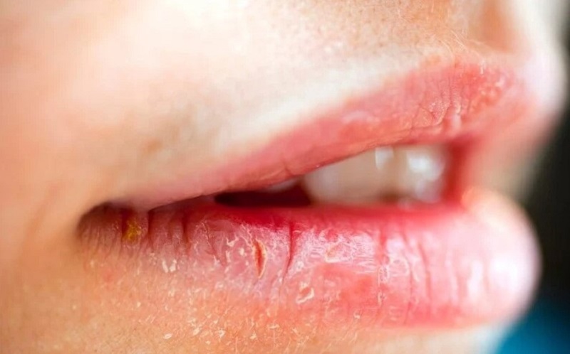 Môi sau phun bị thiếu độ ẩm gây ngứa ngáy