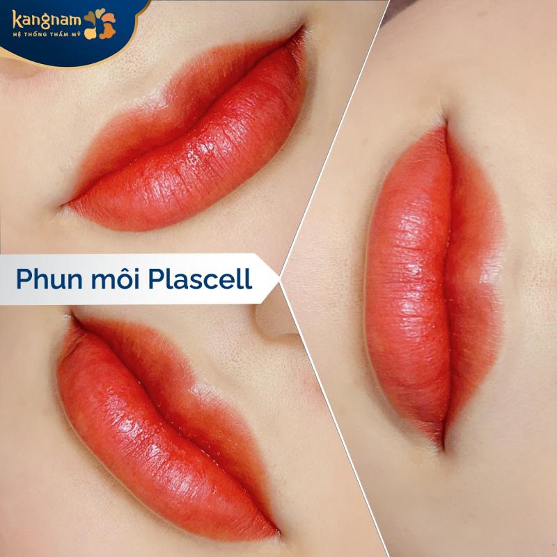 Kangnam ứng dụng phun môi Plascell hiện đại, giúp đôi môi tươi trẻ, tự nhiên