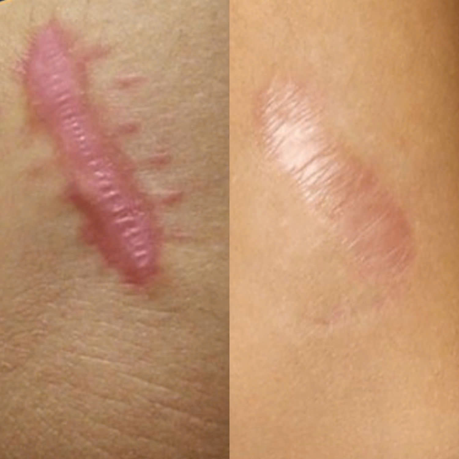 Khách hàng đều cảm thấy hài lòng với kết quả trị sẹo lồi