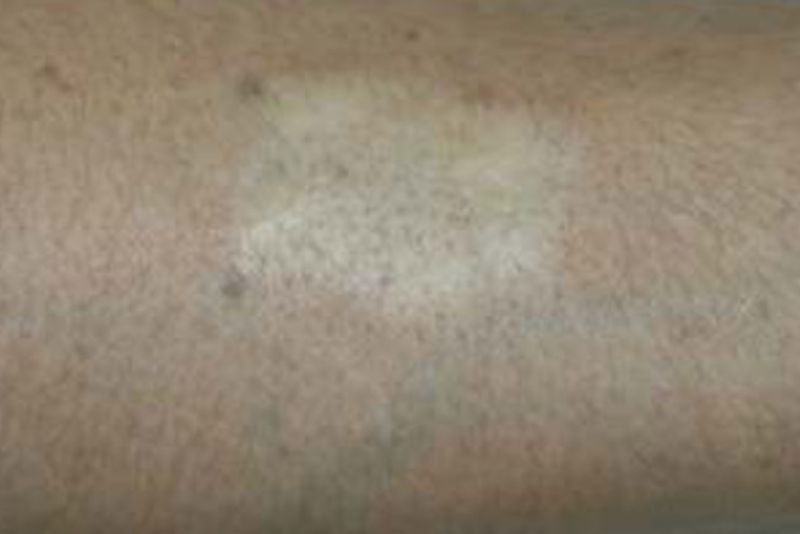 Da có thể bị tăng hoặc giảm sắc tố sau khi xóa xăm