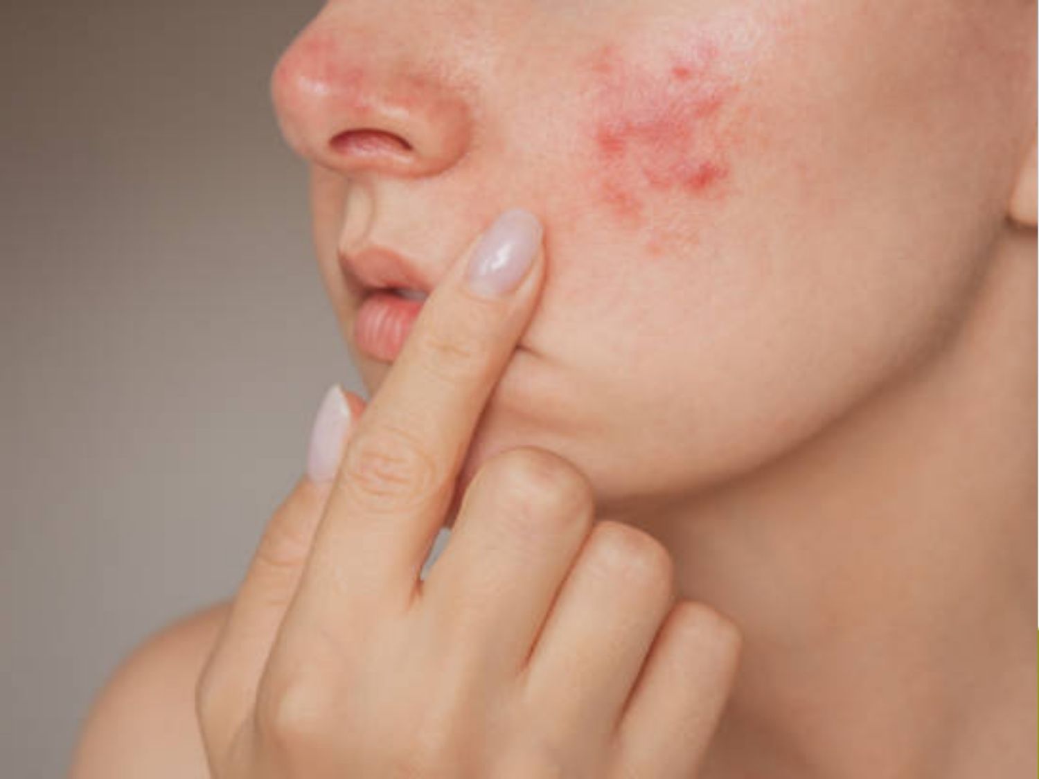 Đang bị mụn viêm nặng, mụn mủ không nên triệt lông mặt