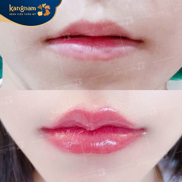 Môi trên mỏng và không có đường nét rõ ràng vẫn có thể cắt môi tim